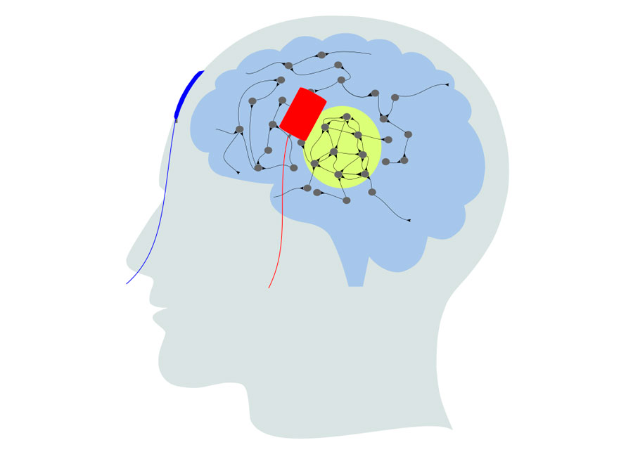 Graphische Darstellung einer transkraniellen Hirnstimulation/ Illustration of a transcranial brain stimulation