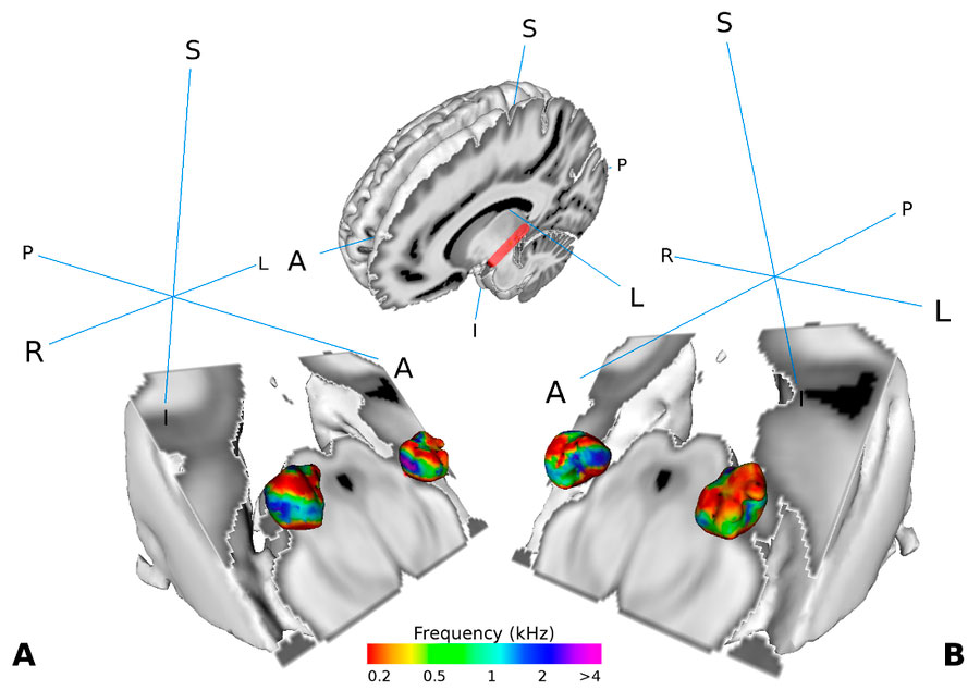 Darstellung des medialen Kniehöckers im Gehirn von menschlichen Testpersonen /Visualization of the medial geniculate body (MGB) in the brain of human test persons